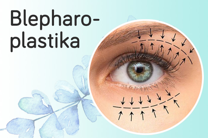 blepharoplastika-hornch a dolnch-vieok